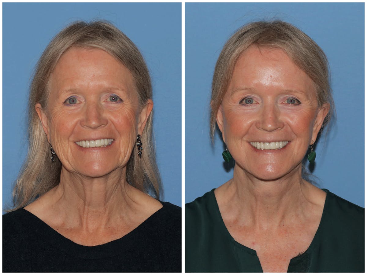 Preservation Facelift Before & After Gallery - Patient 243869 - Image 10