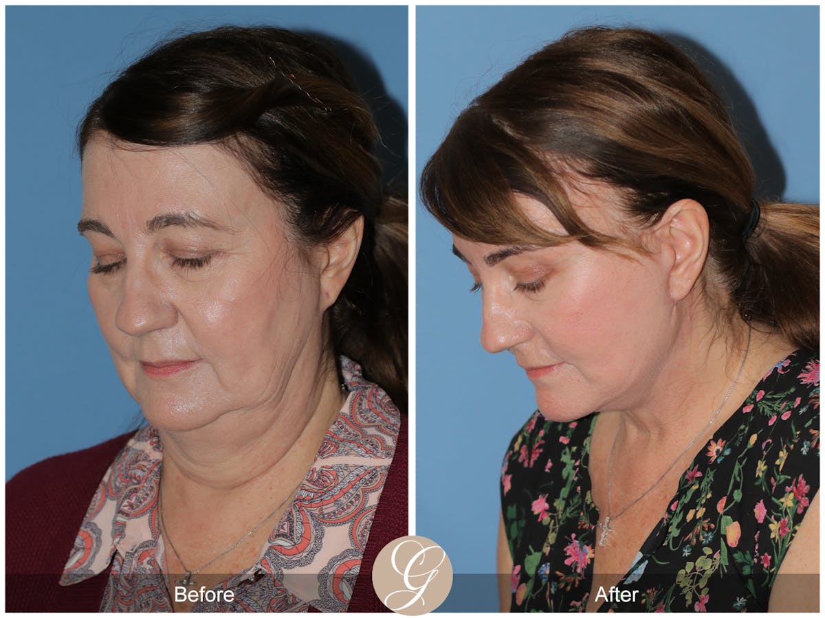 Preservation Facelift Before & After Gallery - Patient 134080 - Image 12