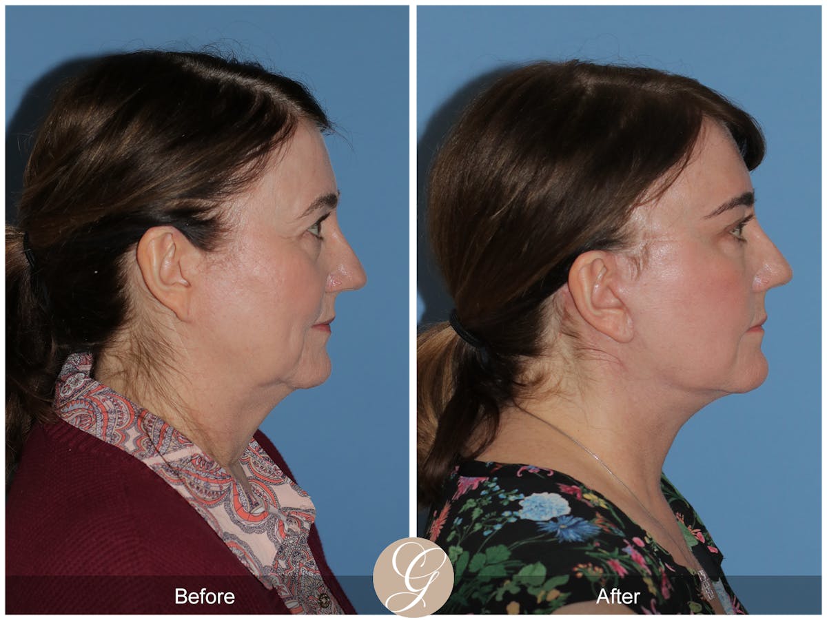 Preservation Facelift Before & After Gallery - Patient 134080 - Image 15