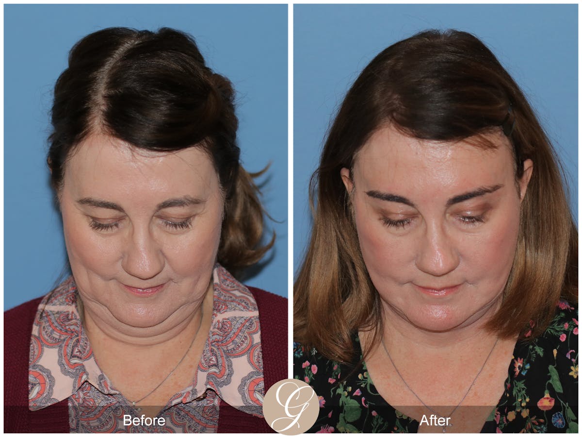 Preservation Facelift Before & After Gallery - Patient 134080 - Image 14