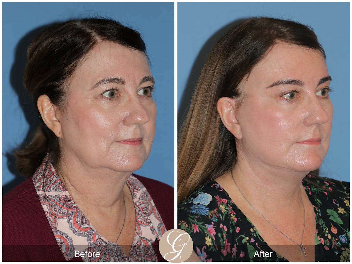Preservation Facelift Before & After Gallery - Patient 134080 - Image 11
