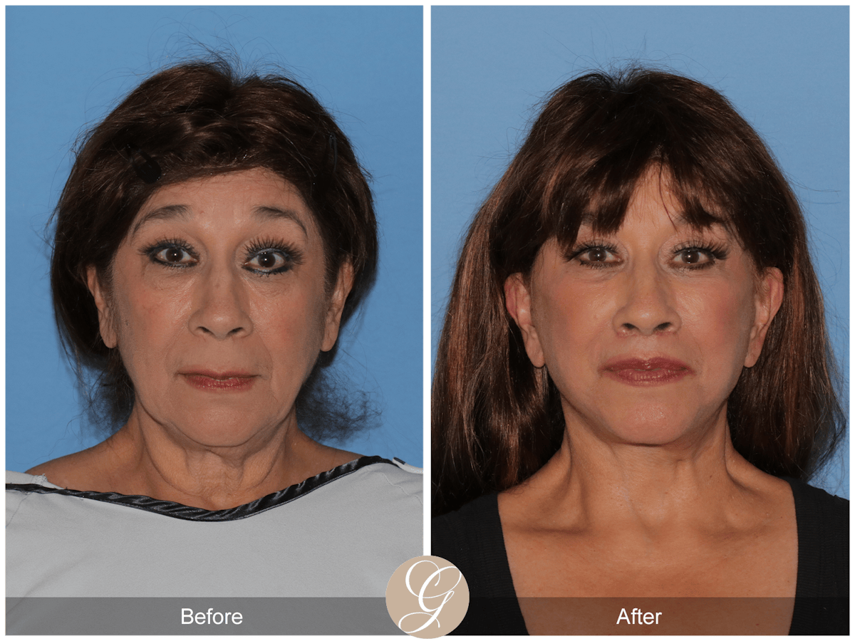 Deep Plane Facelift Before & After Gallery - Patient 991071 - Image 1