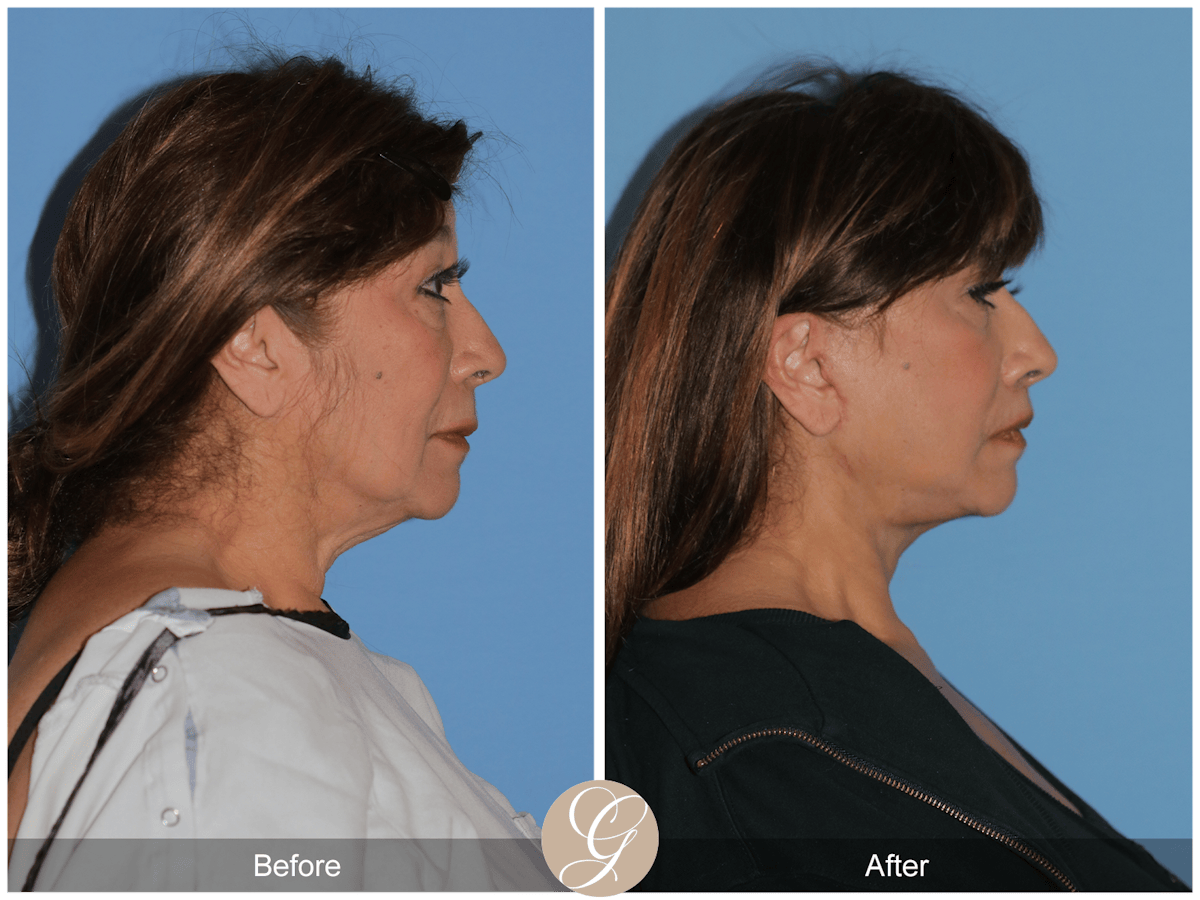 Deep Plane Facelift Before & After Gallery - Patient 991071 - Image 9