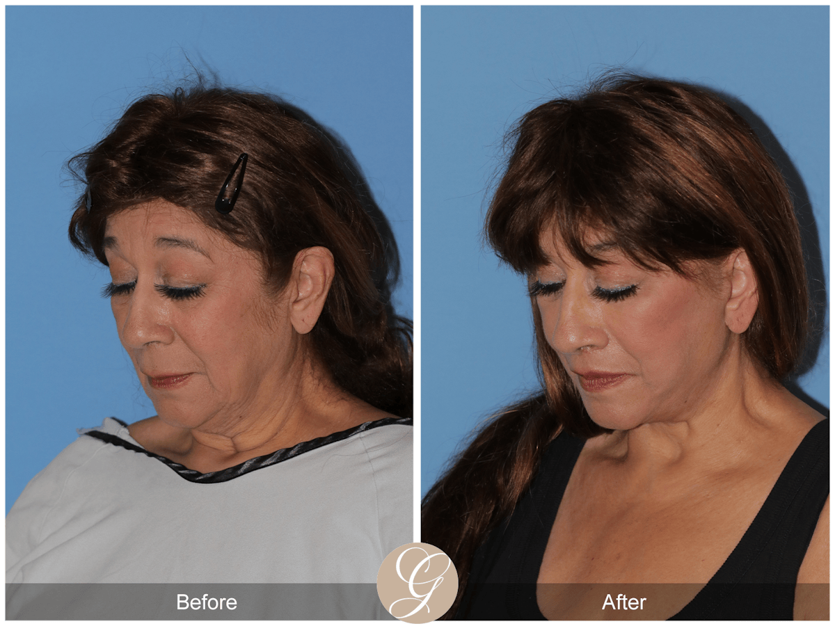 Deep Plane Facelift Before & After Gallery - Patient 991071 - Image 5