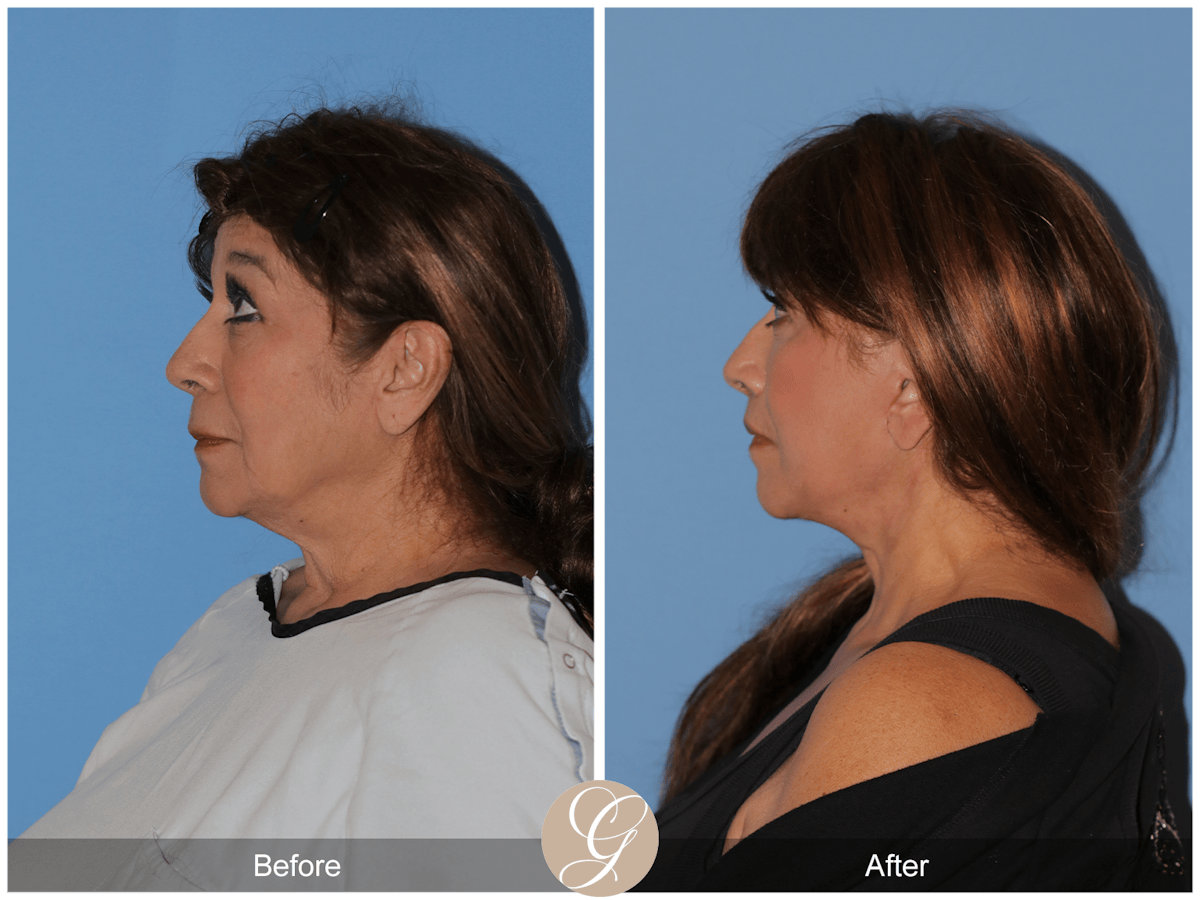 Deep Plane Facelift Before & After Gallery - Patient 991071 - Image 8