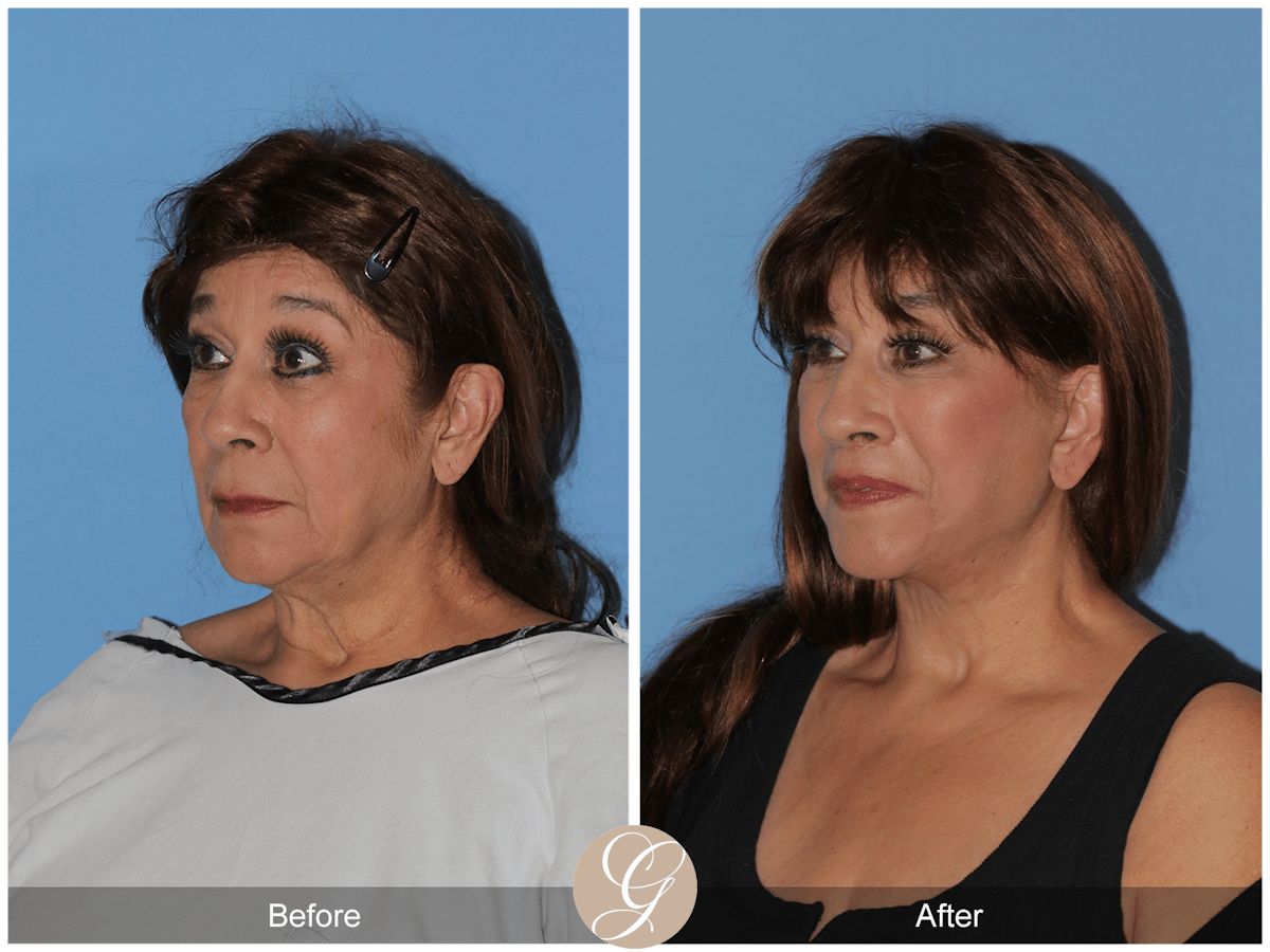 Deep Plane Facelift Before & After Gallery - Patient 991071 - Image 6