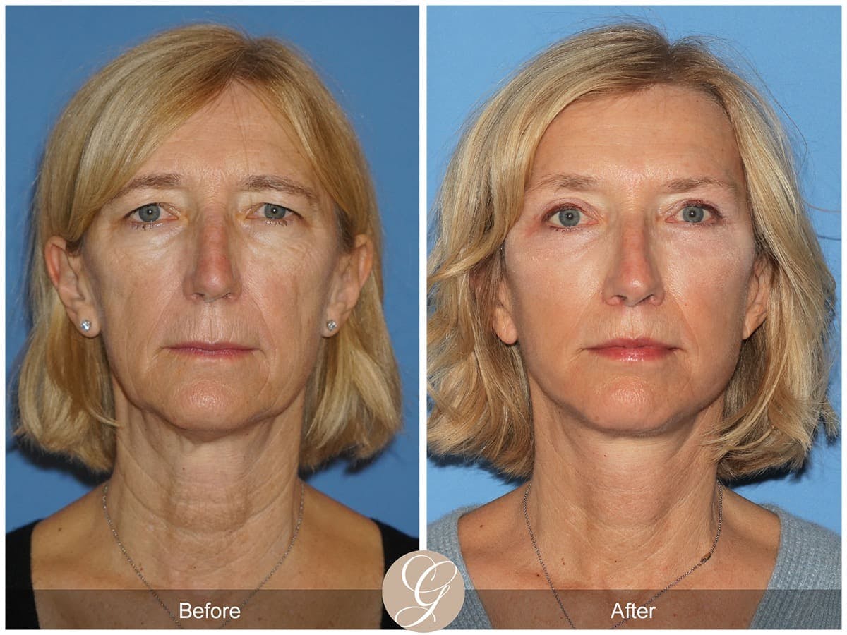 Deep Plane Facelift Before & After Gallery - Patient 200362 - Image 1
