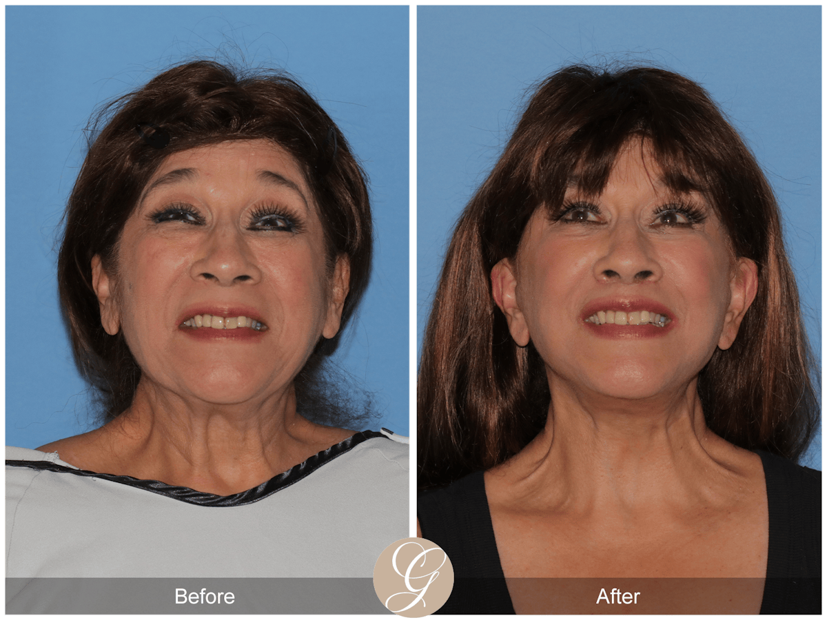 Deep Plane Facelift Before & After Gallery - Patient 991071 - Image 4