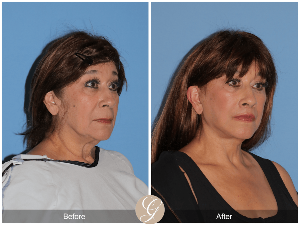 Deep Plane Facelift Before & After Gallery - Patient 991071 - Image 7