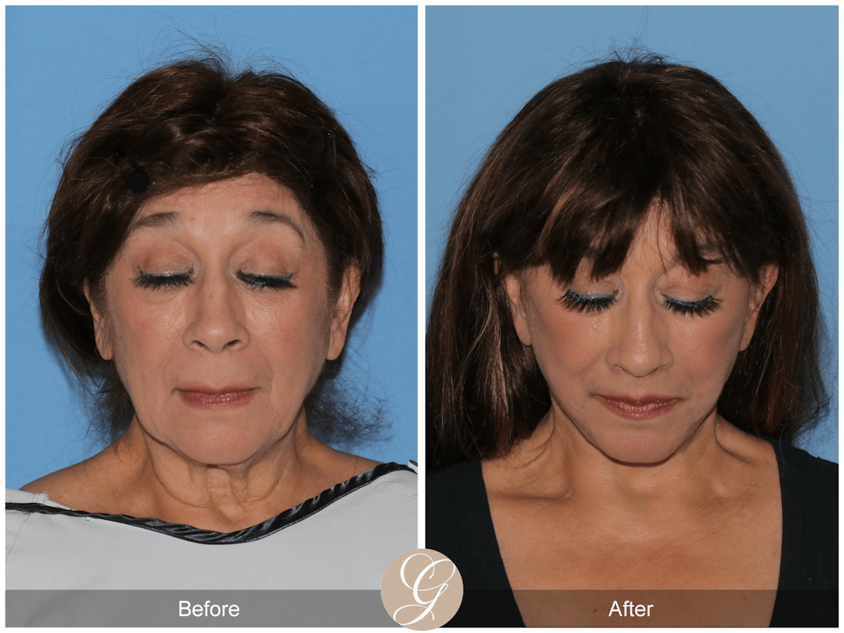 Deep Plane Facelift Before & After Gallery - Patient 991071 - Image 3