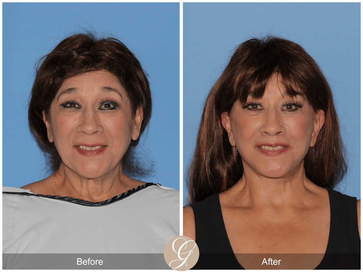 Deep Plane Facelift Before & After Gallery - Patient 991071 - Image 2
