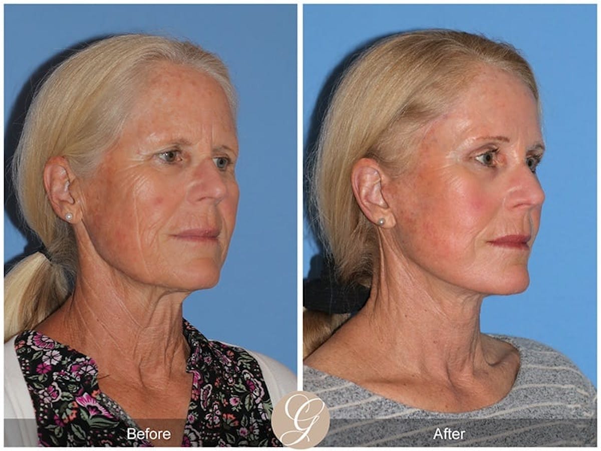 Deep Plane Facelift Before & After Gallery - Patient 154991 - Image 2