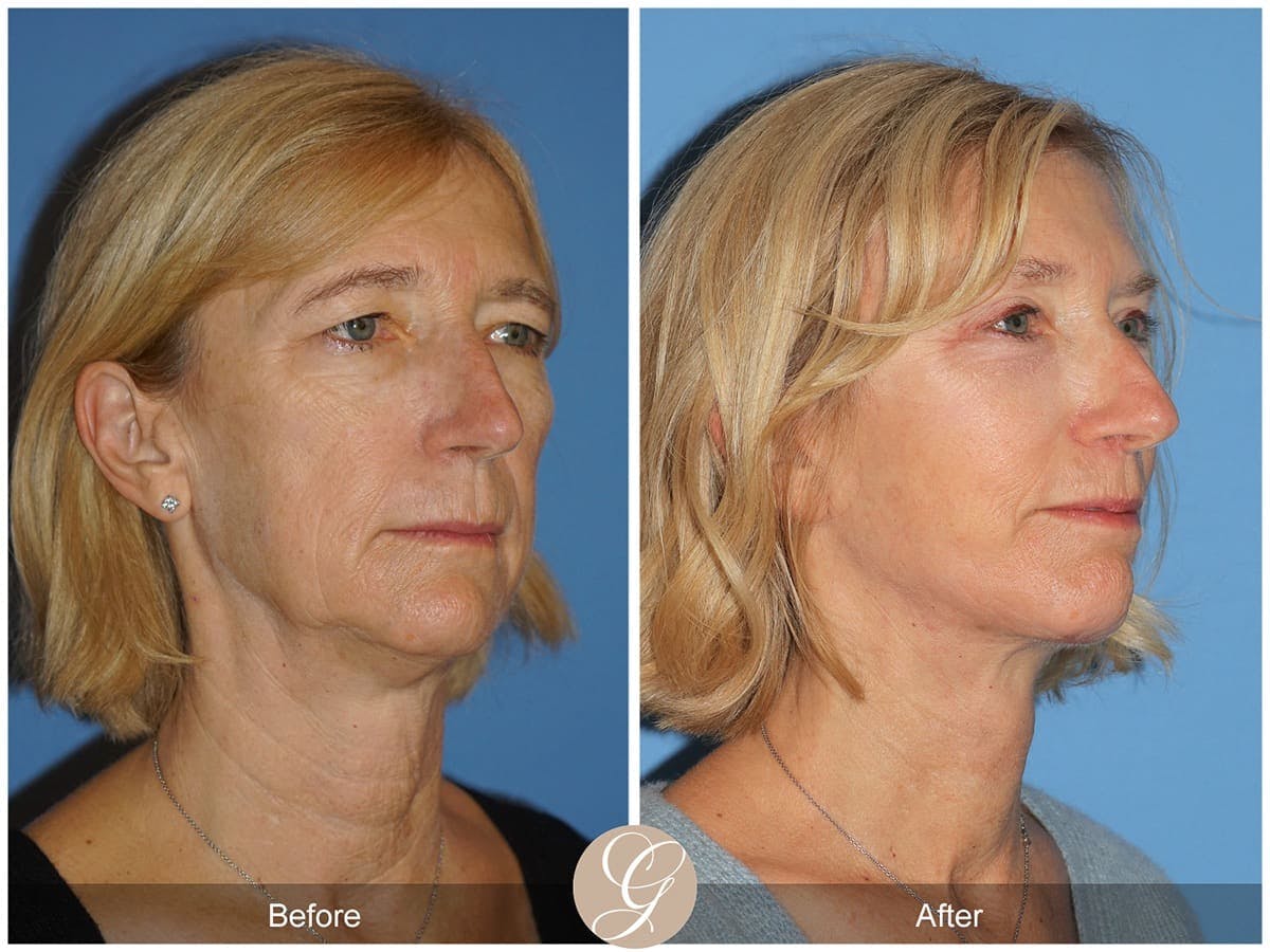 Deep Plane Facelift Before & After Gallery - Patient 200362 - Image 3