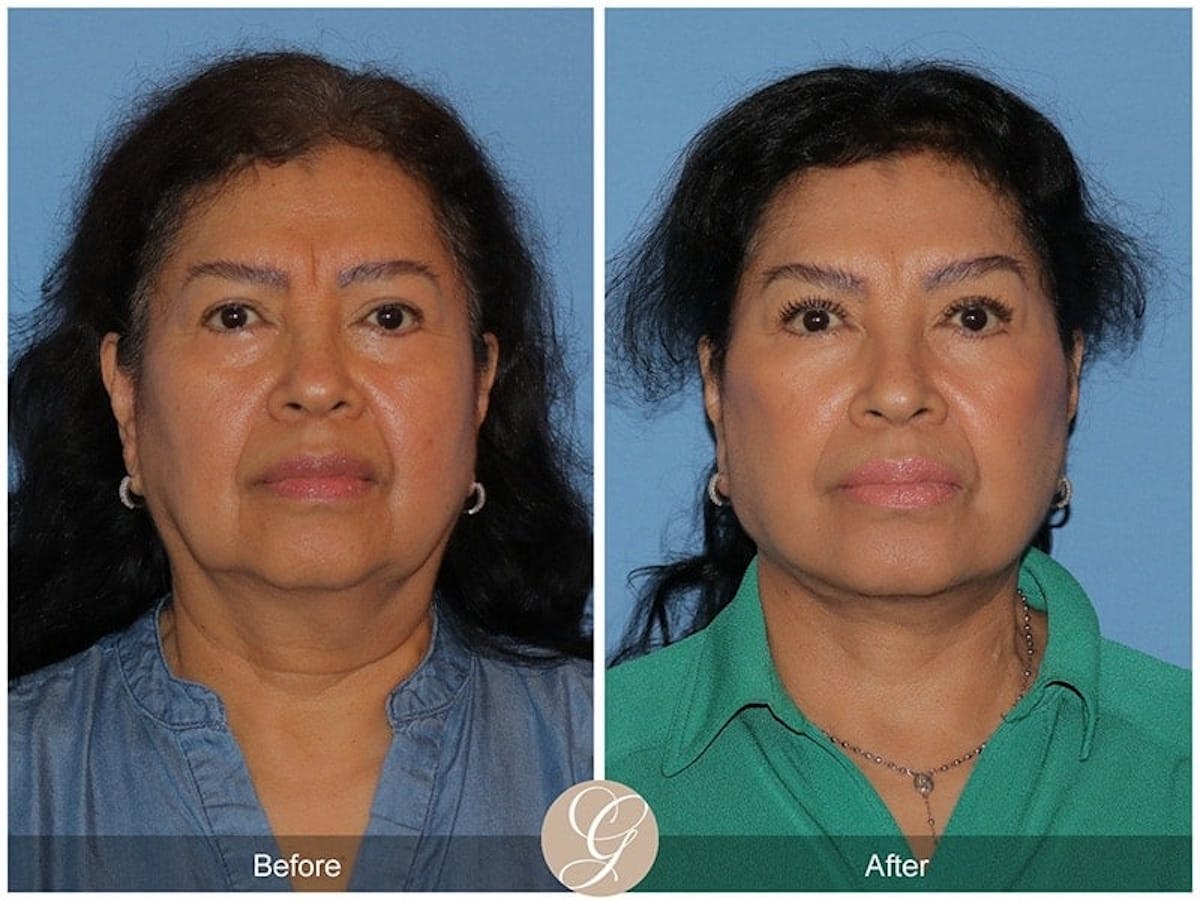 Deep Plane Facelift Before & After Gallery - Patient 114870 - Image 1