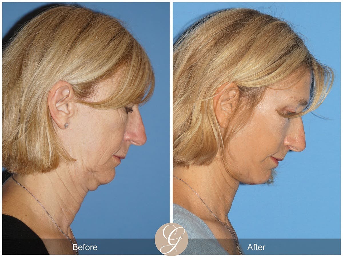 Deep Plane Facelift Before & After Gallery - Patient 200362 - Image 2