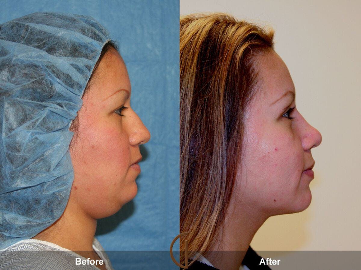 Chin Augmentation Before & After Gallery - Patient 843194 - Image 1