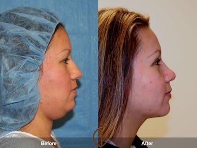 Chin Augmentation Before & After Gallery - Patient 843194 - Image 1