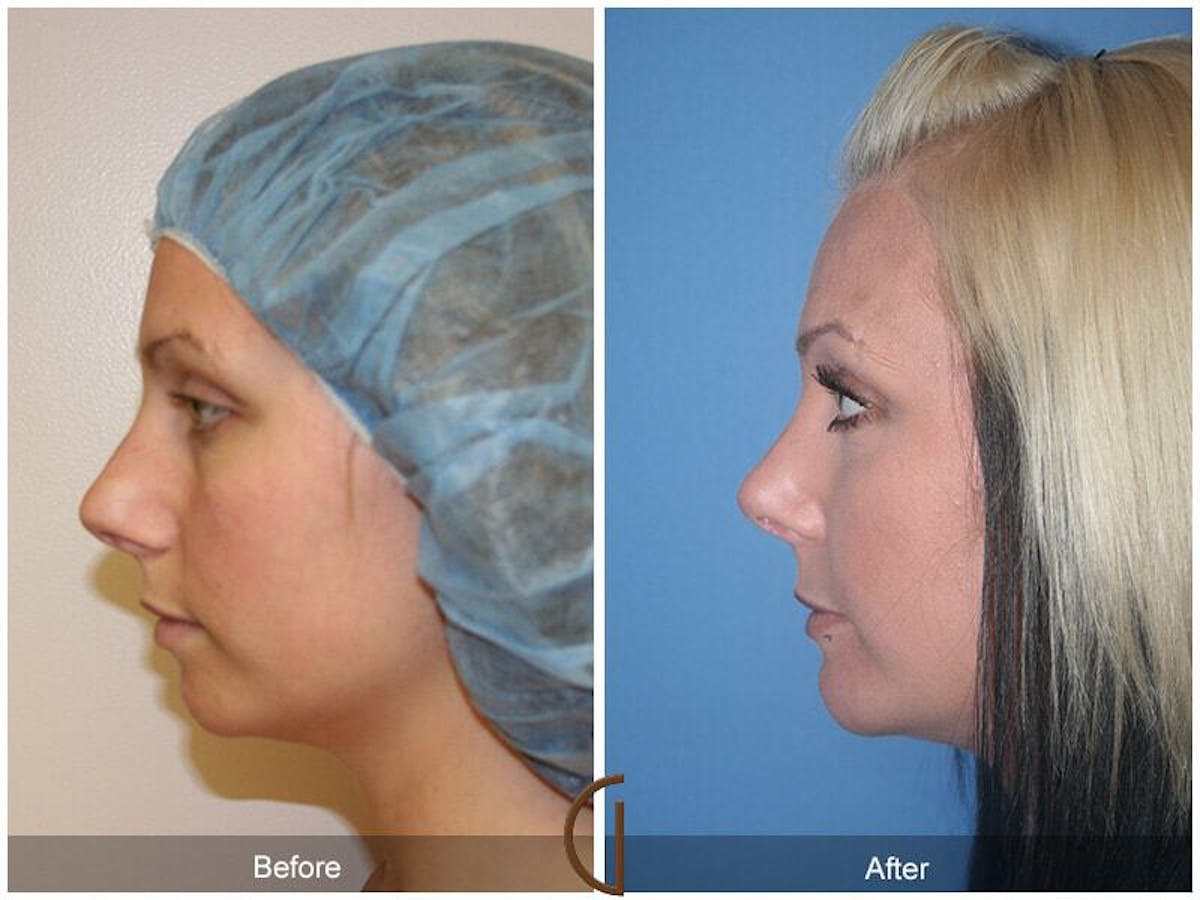Chin Augmentation Before & After Gallery - Patient 189244 - Image 1