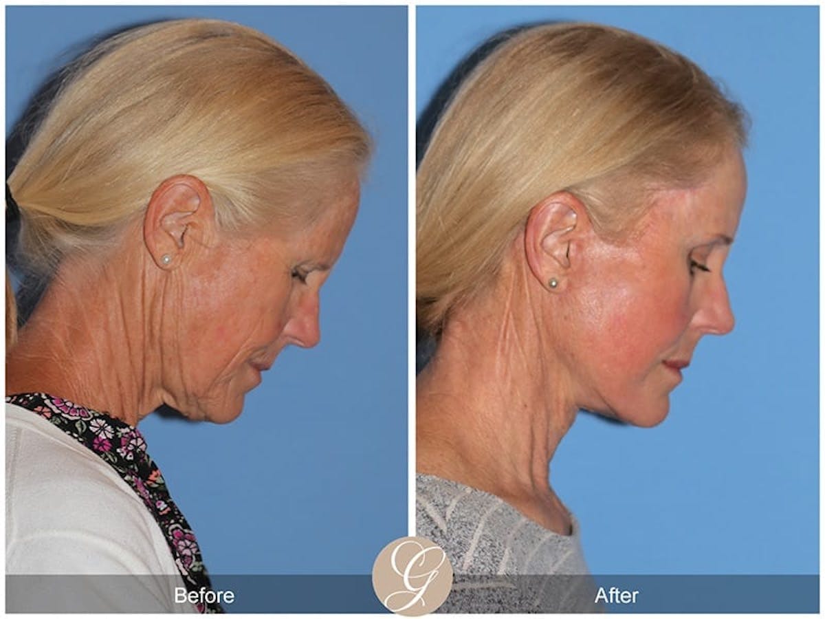Deep Plane Facelift Before & After Gallery - Patient 154991 - Image 3