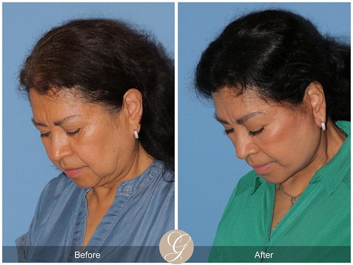 Deep Plane Facelift Before & After Gallery - Patient 114870 - Image 2