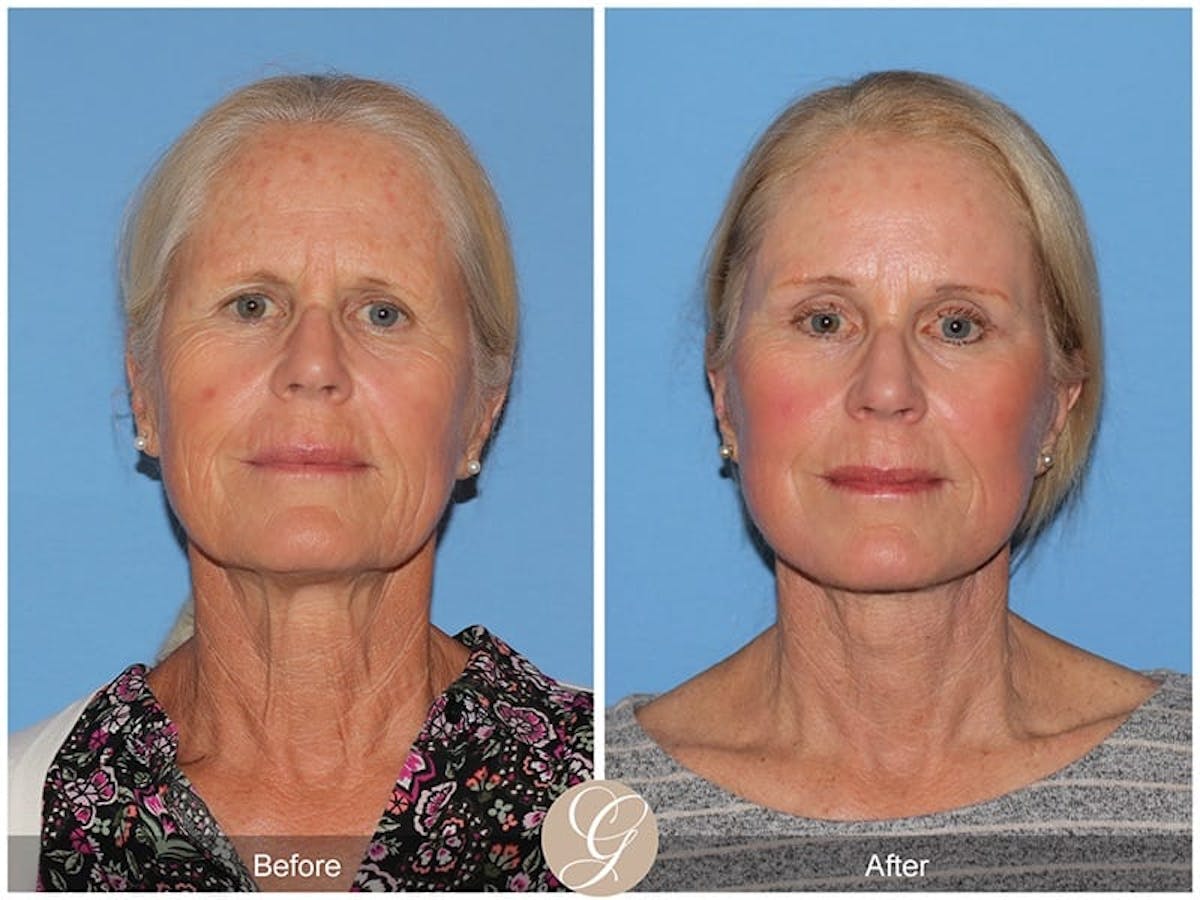 Deep Plane Facelift Before & After Gallery - Patient 154991 - Image 1
