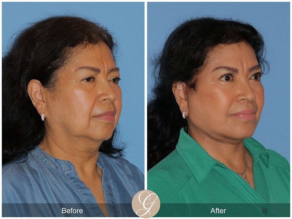 Deep Plane Facelift Before & After Gallery - Patient 114870 - Image 3