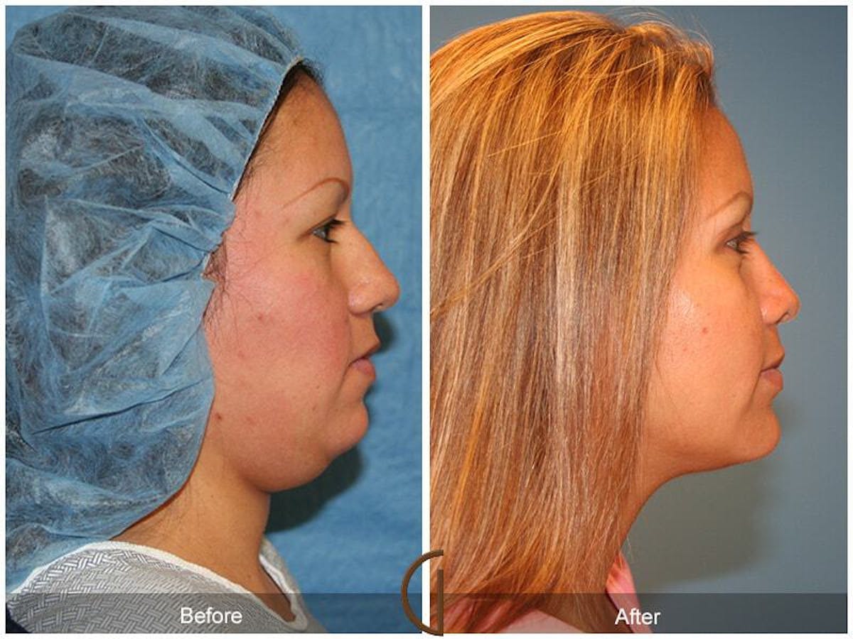 Chin Augmentation Before & After Gallery - Patient 331337 - Image 3