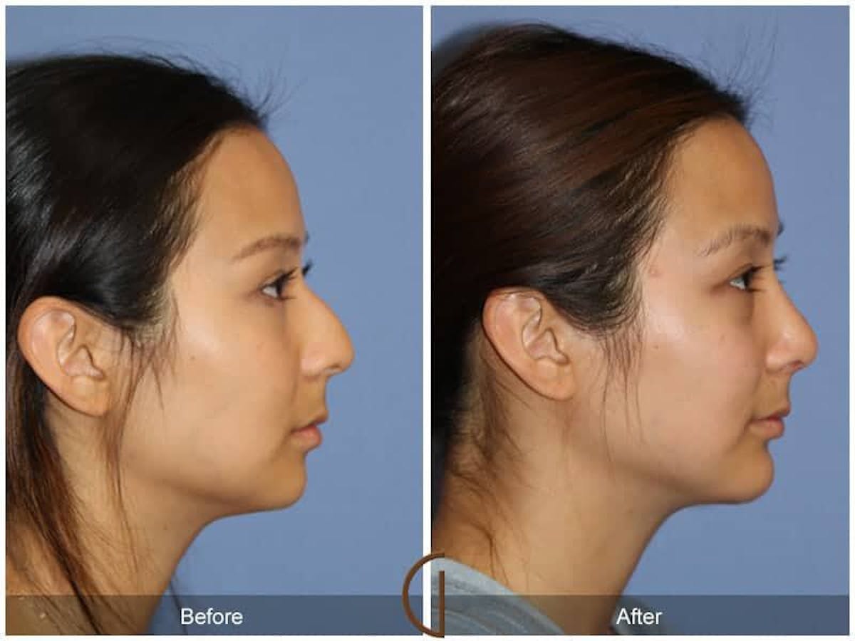 Chin Augmentation Before & After Gallery - Patient 108053 - Image 3