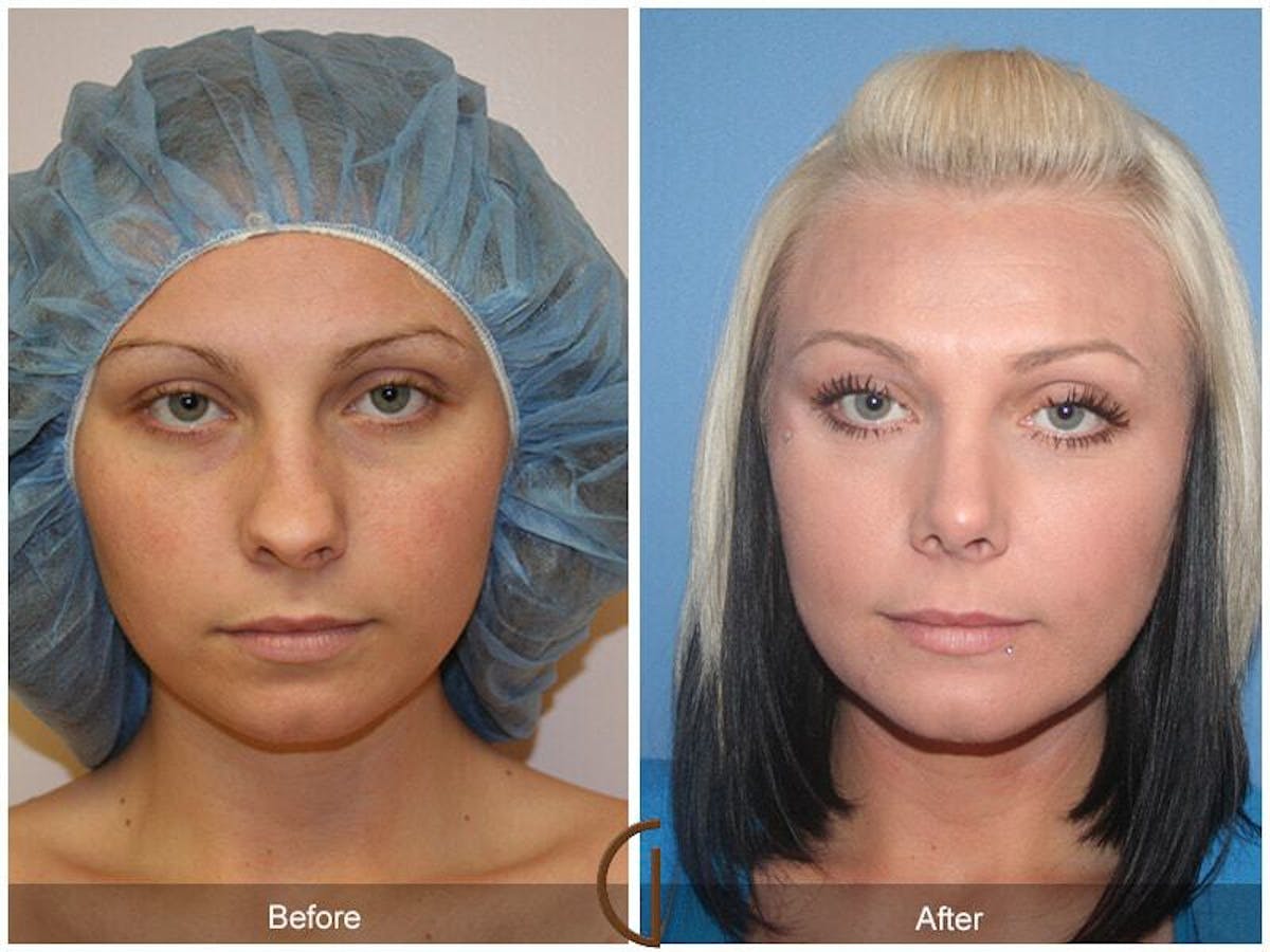 Chin Augmentation Before & After Gallery - Patient 189244 - Image 2