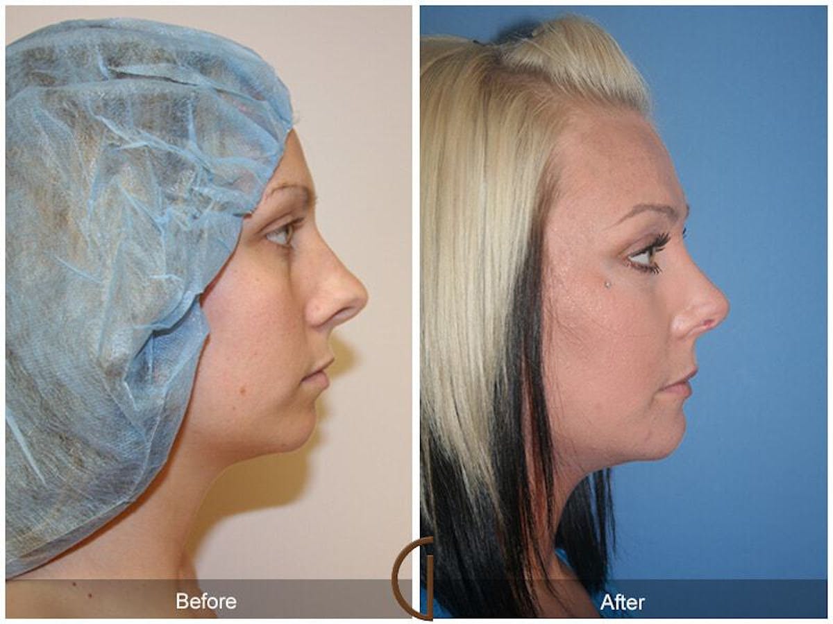 Chin Augmentation Before & After Gallery - Patient 189244 - Image 3