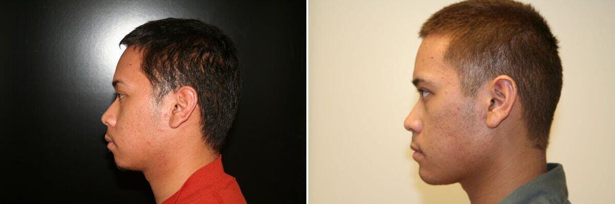 Chin Augmentation Before & After Gallery - Patient 171990 - Image 1