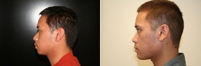 Chin Augmentation Before & After Gallery - Patient 171990 - Image 1