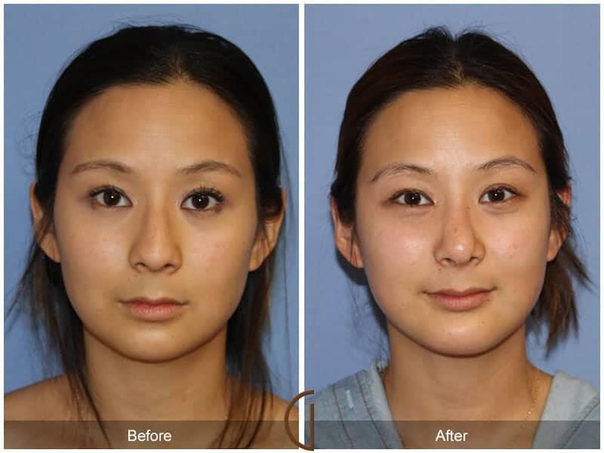 Chin Augmentation Before & After Gallery - Patient 108053 - Image 2