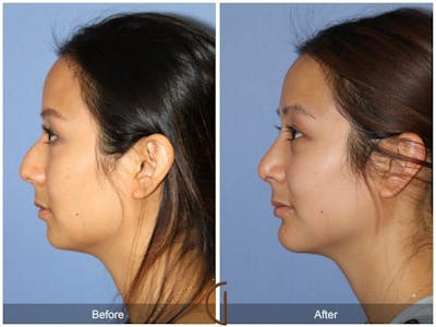Chin Augmentation Before & After Gallery - Patient 108053 - Image 1