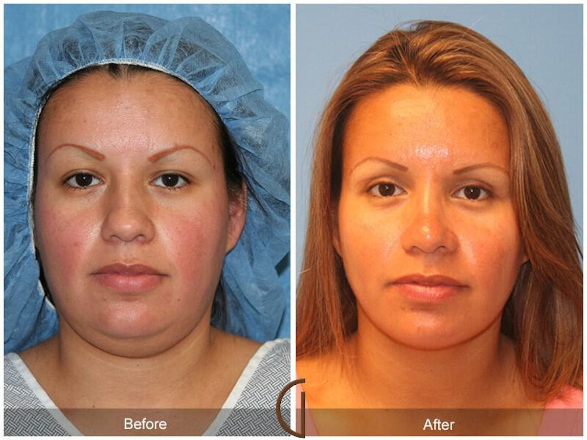 Chin Augmentation Before & After Gallery - Patient 331337 - Image 2