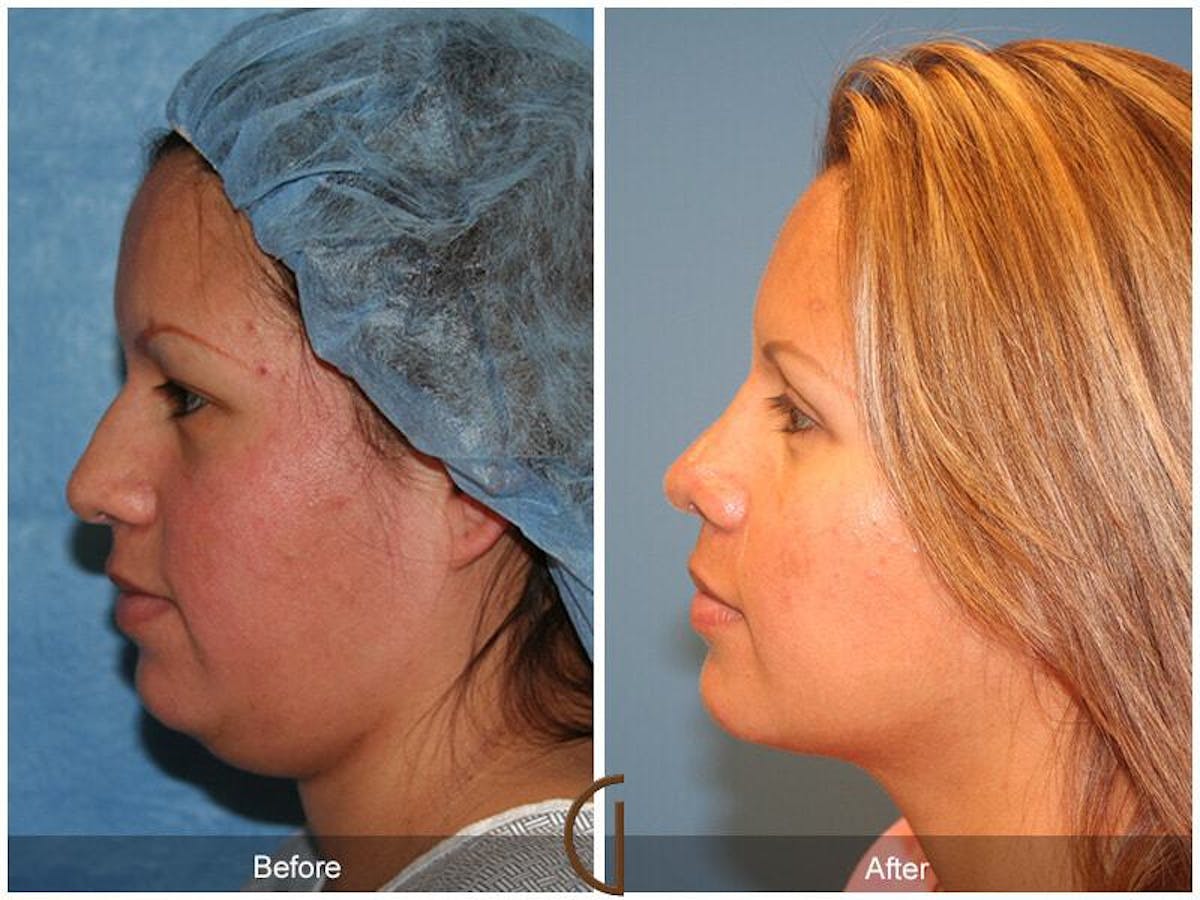 Chin Augmentation Before & After Gallery - Patient 331337 - Image 1