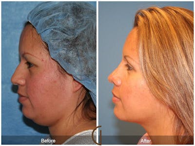 Chin Augmentation Before & After Gallery - Patient 331337 - Image 1