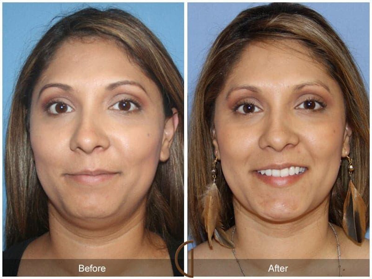Chin Augmentation Before & After Gallery - Patient 159394 - Image 2