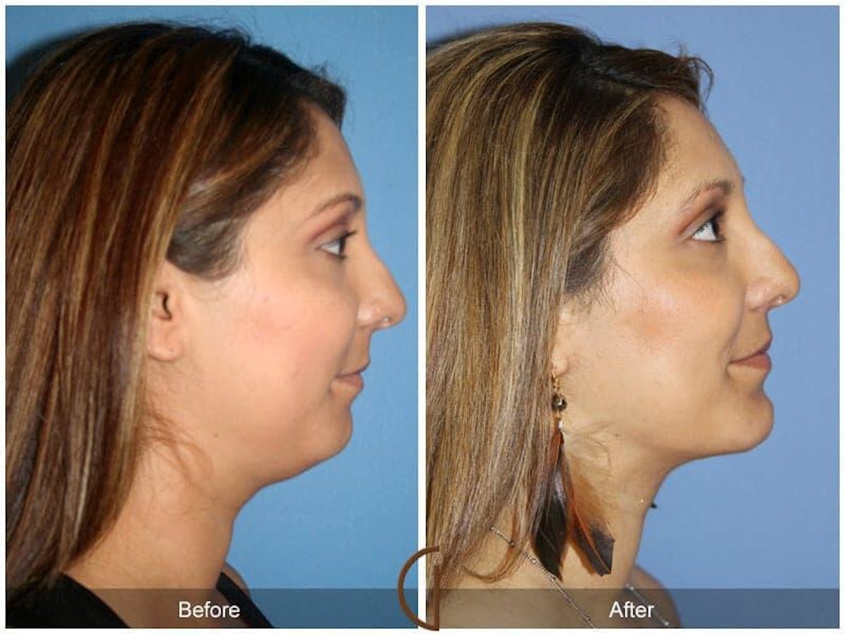 Chin Augmentation Before & After Gallery - Patient 159394 - Image 3