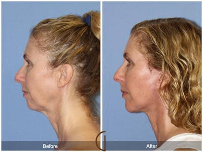 Chin Augmentation Before & After Gallery - Patient 182357 - Image 1