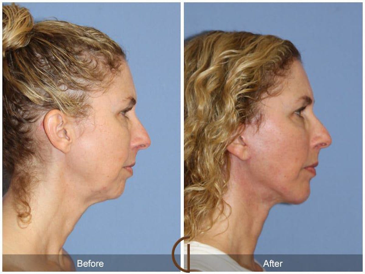Chin Augmentation Before & After Gallery - Patient 182357 - Image 2