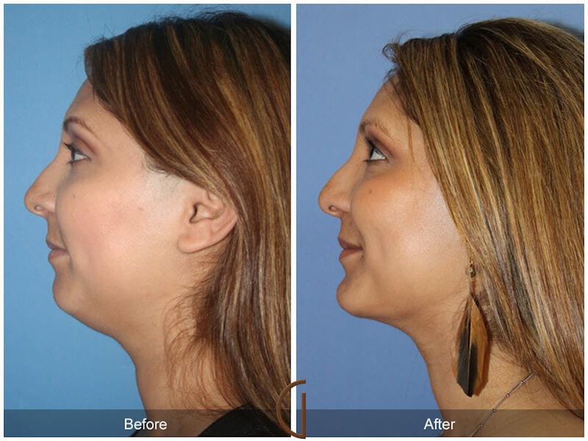 Chin Augmentation Before & After Gallery - Patient 159394 - Image 1