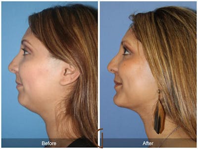 Chin Augmentation Before & After Gallery - Patient 159394 - Image 1