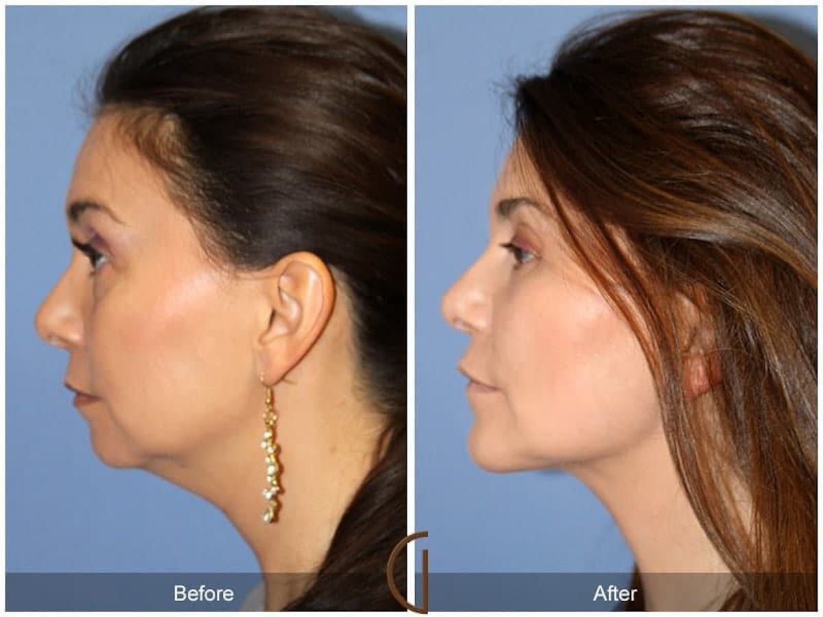 Chin Augmentation Before & After Gallery - Patient 558945 - Image 1