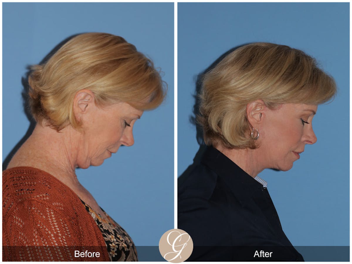 Preservation Facelift Before & After Gallery - Patient 927687 - Image 3