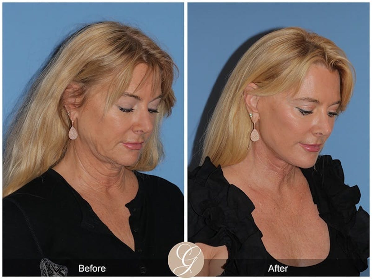 Preservation Facelift Before & After Gallery - Patient 408947 - Image 3