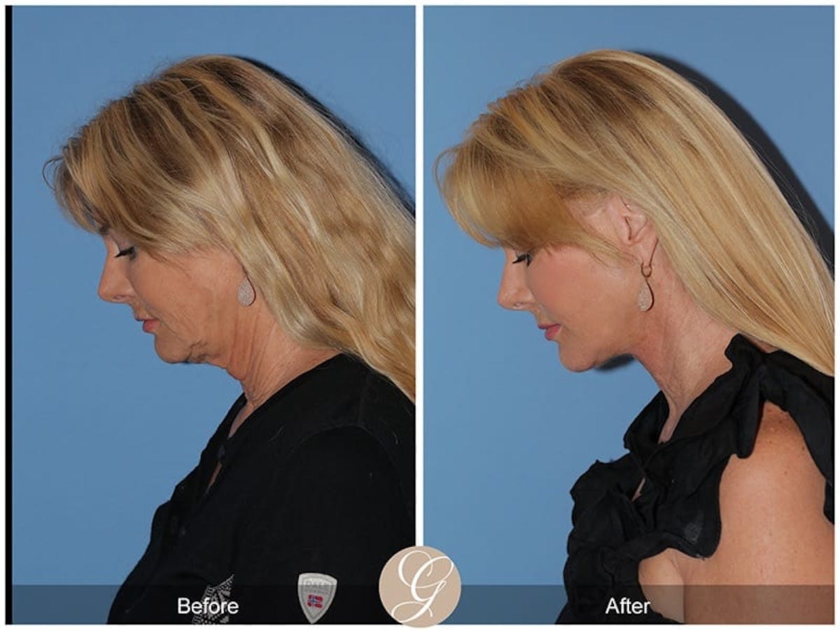 Preservation Facelift Before & After Gallery - Patient 408947 - Image 2