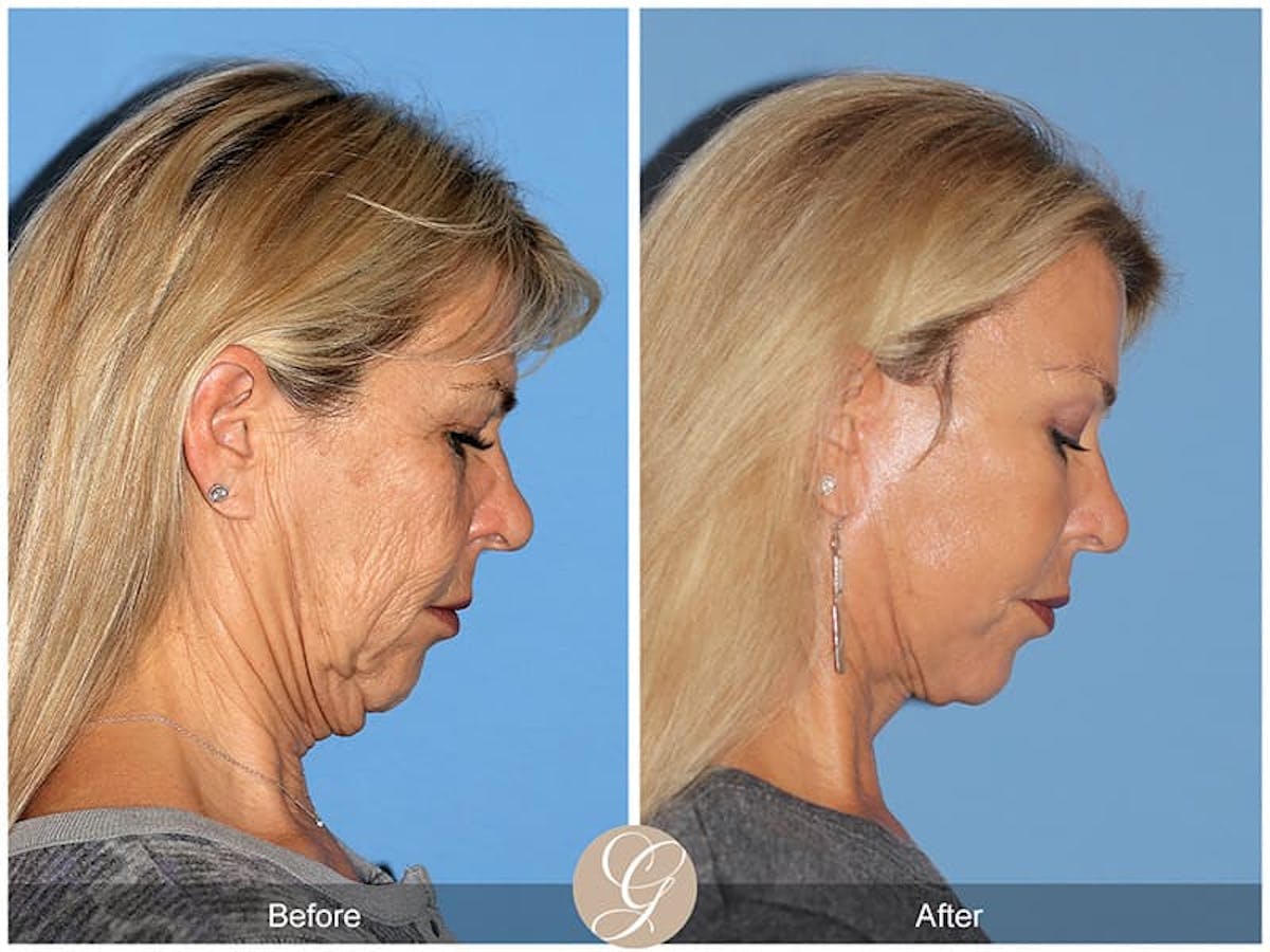 Preservation Facelift Before & After Gallery - Patient 150273 - Image 2