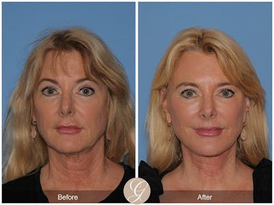 Deep Plane Facelift Before & After Gallery - Patient 338375 - Image 1