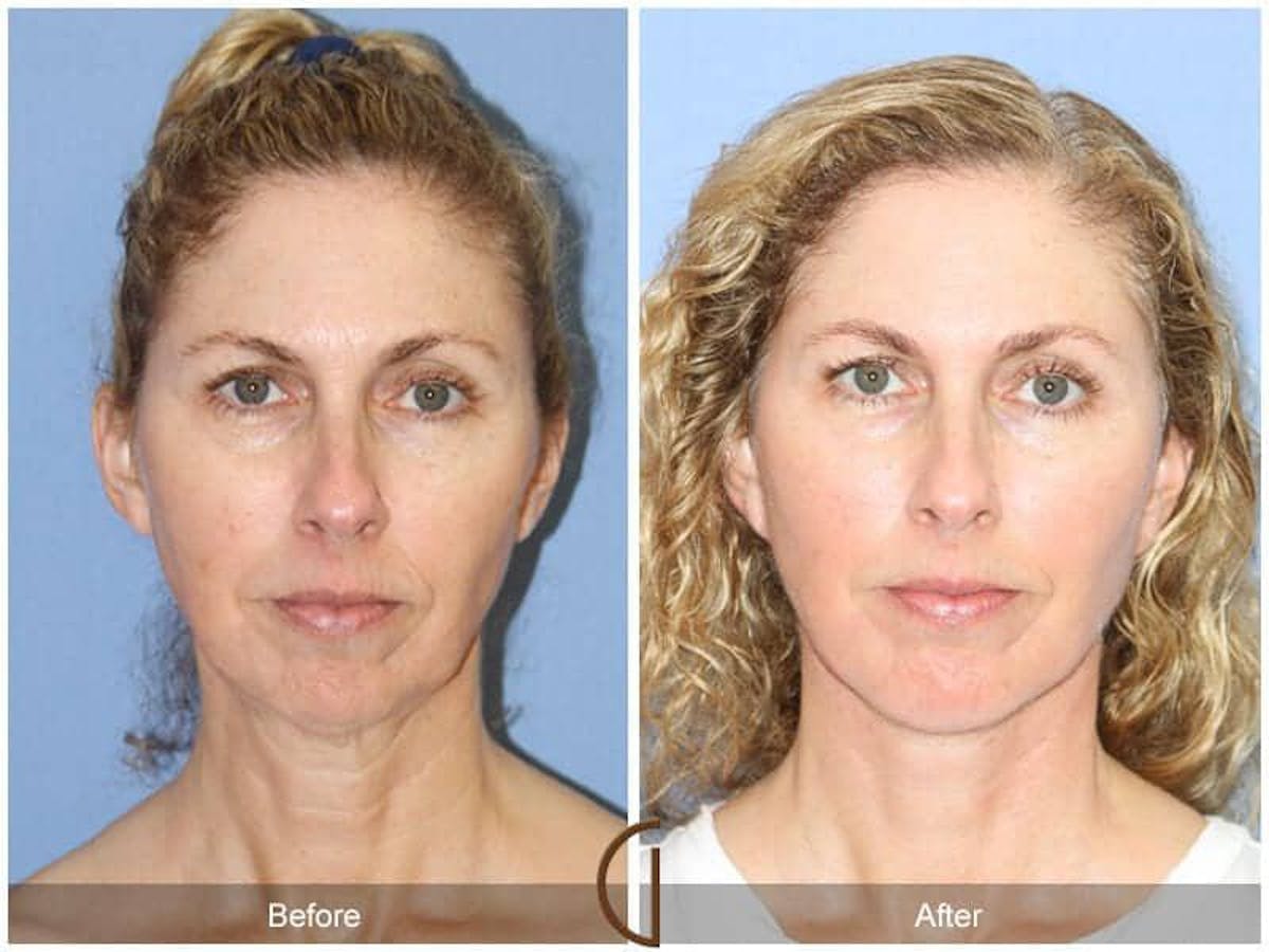 Chin Augmentation Before & After Gallery - Patient 182357 - Image 3